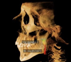 Restrictive Airway Volume
